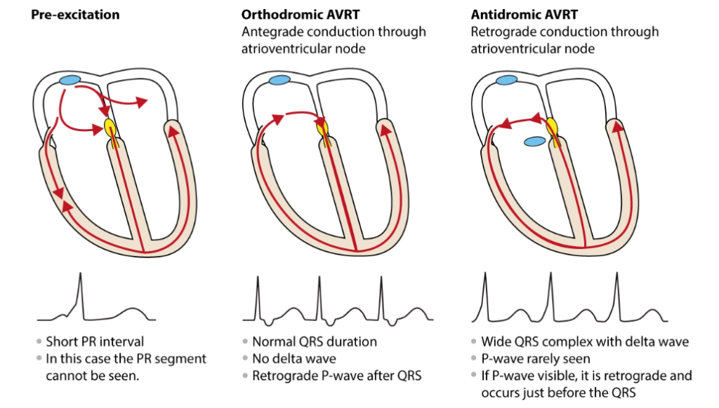 What Is Rp Interval Pre-excitation syndromes – MyNotes