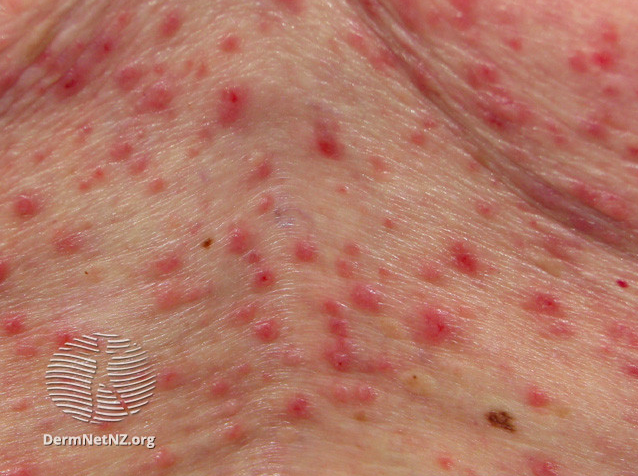 Grover disease – My notes