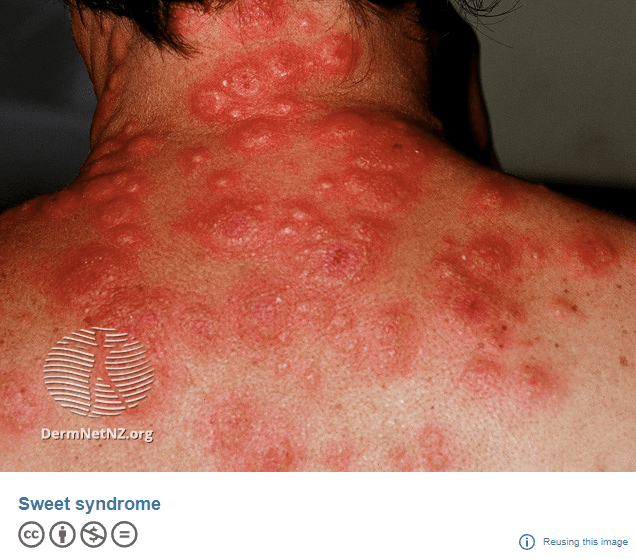 Acute Febrile Neutrophilic Dermatosis (Sweet Syndrome) – My notes